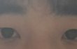 남자 쌍수 8일차인데 잘된거같아 ㅜㅜ?