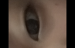 쌍수해야할 눈인가요ㅠ