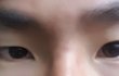 남자 눈 성형 어떻게할까요