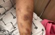 (재업로드)친구의 남자친구가 다쳣습니다