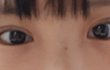 쌍커풀시름