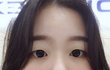 쌍수할까말까??사진있음