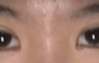 쌍수 앞트임 패인 흉<혐주의>