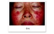 피부때문에 정말 죽을거같아