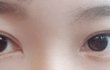 [쌍수후기] 나 결국 쌍수함