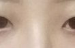중3인데 쌍수할까 ㅠㅠ