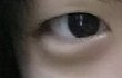 일년반 지난 쌍수후기 ㅎㅎ