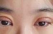 쌍수 절개하고 일주일하고 하루ㅠㅠ