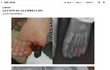 수술후 발가락이 이렇게..