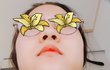 콧구멍 축소수술