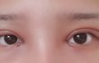 댓글좀 ㅠㅠ눈매교정 앞트임 매몰 2일차 어때???진짜 ㅠㅠ꼭 달아줘