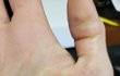 허벅지 피부를 손바닥에 이식한 결과
