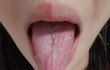 혀 갈라지신분 계신가요?*사진혐주의*
