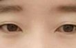 쌍수하는게 나을까요?