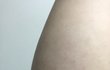 아니 튼살 어케 없애..