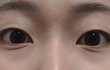 쌍수하면 망하는 눈이 따로 있어?