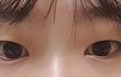 애드라... 나쌍수하는게낫겟지..??ㅠㅠ 제발조언좀해줘ㅜㄴ