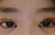 애드라... 나쌍수했는데 짝짝이로 될까..??ㅠㅠ 제발도와줘