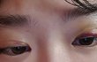쌍수+앞트임했는데 망한걸까..?? 해본애들 도와주라ㅠㅠ