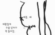 제왕절개 수술 후 상처가 함몰 되었어요.