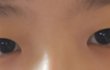 쌍수후기 앞트임이랑 절개 비포 애프터
