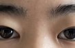 쌍수재수술하면 망하려나?