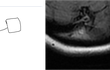 뇌 mri 찍었는데 이물질 발견했어요.