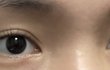 아웃라인 쌍수 2년차 후기