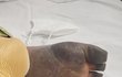 백신 부작용으로 다리 절단을 한 제친구를 도와주세요!