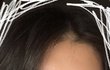 정수리 탈모 맞지..?