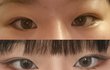++추가)쌍수하는 게 나을까