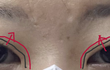 성형 쌍수 재수술 조언 부탁드립니다 (윗트임 고민(