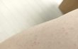 모공각화증  어떻게 관리해야함?
