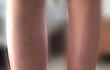 선천적 장애로 두 다리 두께가 달라서 스트레스야