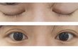 나 쌍수 어땡