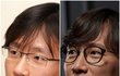 시사직격 앰씨 임재성 변호사 성형전후 비포&애프터