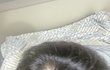 탈모 많이 심한가요