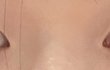 쌍수 3달차인데 어때?