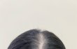 26살 두피문신 후기