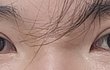 나 쌍수하고 남상됨