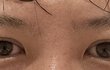 남자 쌍수 40일차인데 어때?