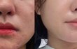 여드름피부 수딩크림 추천해줌