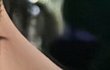 코성형 한달차인데 붓기 언제 빠질까요?