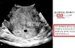 손흥민 협박녀가 '소닉베이비' 닉으로  맘카페에 임신 초음파 사진올리고 쓴 글 떴다는데 ㄷㄷ
