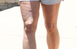 30대부터 다리에 급 생기는 역겨운 덩어리 정체 ㄷㄷ