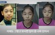 돌출입 교정으로 예뻐진 김연아