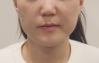 울 언니 리프팅 받은거봐봐 ㅠㅠ
