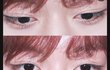 박지훈같은눈 성형으로가능함?