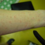 갑자기 온몸에 붉은 <b>반점</b>이 좁쌀처러올라와요