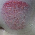 <b>수포</b>가 배에 엄청 많이 났어요